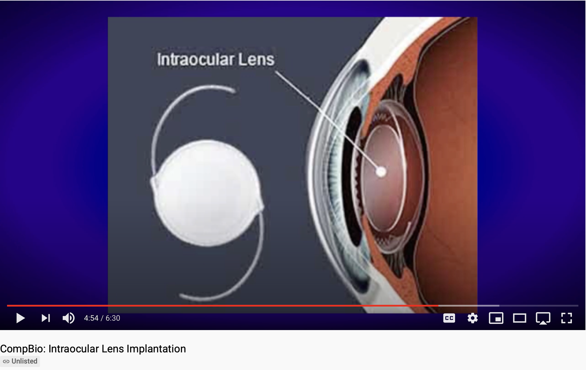 stromen Onderscheid helder Intraocular Lens Implantation (video) - Comparative Biosciences, Inc.